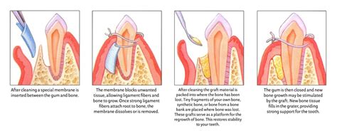 Guided Tissue Regeneration .